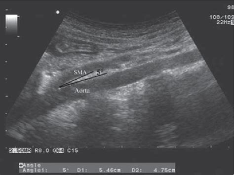 Figure 1 from Laparoscopic Lysis of the Ligament of Treitz for Superior Mesenteric Artery ...