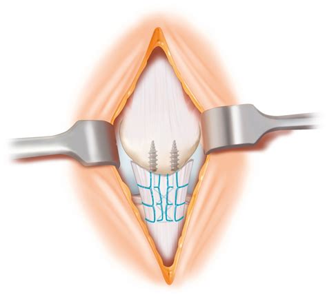 Injuries of the Patellar Tendon | Musculoskeletal Key