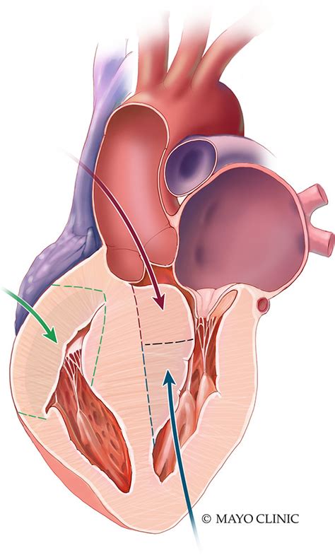 The Surgeons View Of The Left Ventricular Outflow Tract In Congenital