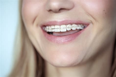 Ceramic Braces Adelaide Clear Orthodontics Orthodontic Smile Practice