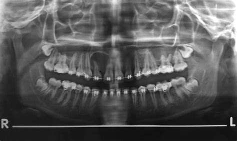 Orthopantomograph Showing A Well Defined Radiolucency With A