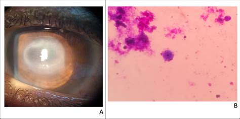 A Case Of Severe Acanthamoeba Keratitis Presented With Immune Ring A Download Scientific