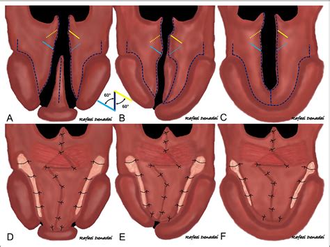 Figure 1 From Reinforcing The Modified Double Opposing Z Plasty