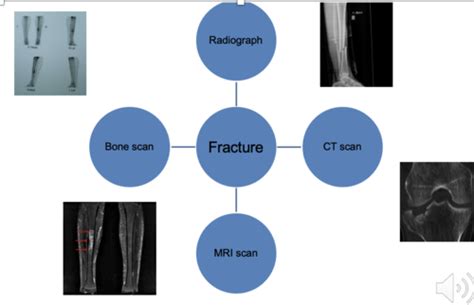 9 1 Management Of Specific Fractures Flashcards Quizlet