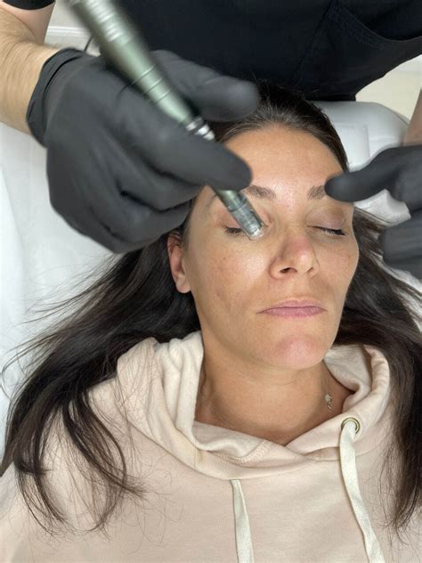 Microneedling Under Eyes The Ultimate Solution At Borsalo Med Spa