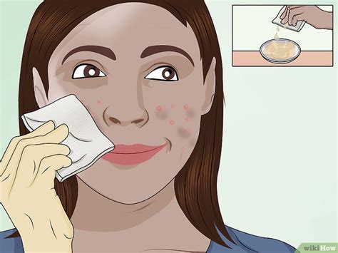 Como Aplicar Um Peeling De Cido Tricloroac Tico