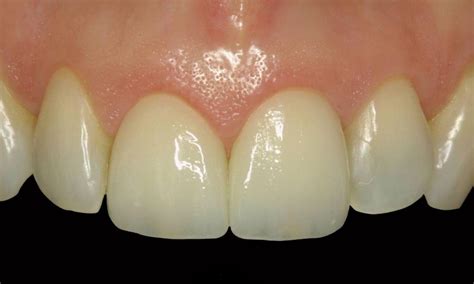 Smile Gallery | Veneers for Front Teeth