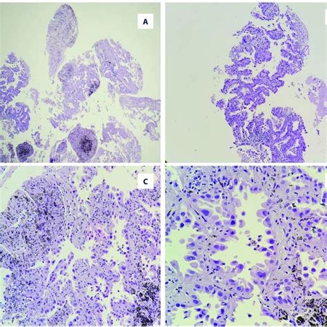 Photomicrographs Of The Histology Of Adenocarcinoma Of The Lung Download Scientific Diagram