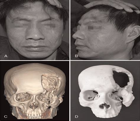 Reconstruction Of Craniomaxillofacial Bone Defects With Cust