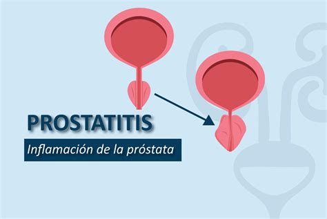 Prostatitis Inflamaci N De La Gl Ndula Prost Tica