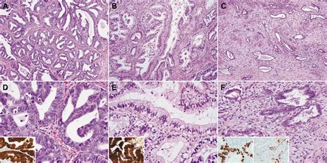 Stromal P16 Overexpression In Gastric Type Mucinous Carcinoma Of The Uterine Cervix Anticancer