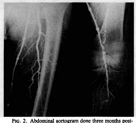 Figure 2 From Bypass Graft To The Isolated Popliteal Artery Segment For The Nonhealing Below The