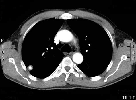 Pulmonary hamartoma | Radiology Case | Radiopaedia.org | Radiology ...