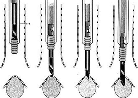 Transbronchial Needle Aspiration For Histology By Wang Needle