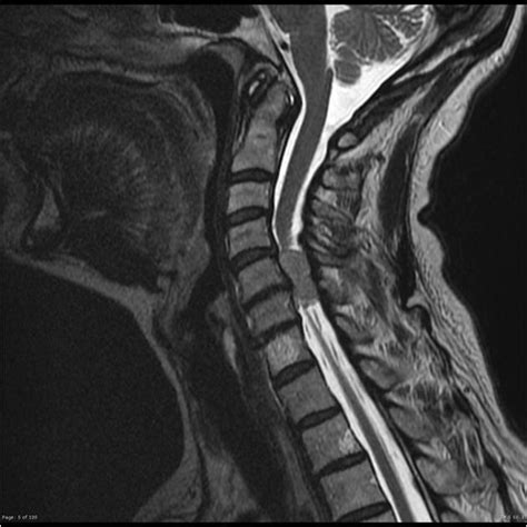 Spinal Meningioma Radiology Case