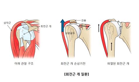 어깨 회전근개 파열 원인과 증상 치료법 네이버 블로그