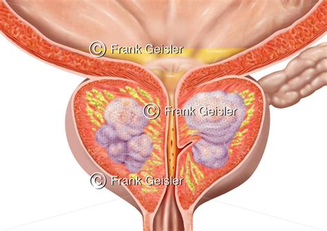 Anatomie Der Prostata Mit Benignem Prostata Hyperplasie Syndrom Bph