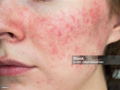 Rosacea Causes And Prevention Tips Su Skin Fort Myers Fl