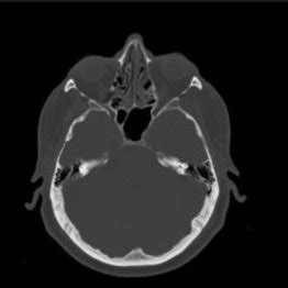 A Preoperative Sinus Computed Tomography CT Scan With Two Axial And