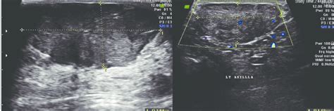 (a) Baseline sonographic image of the left axillary tail lesion ...