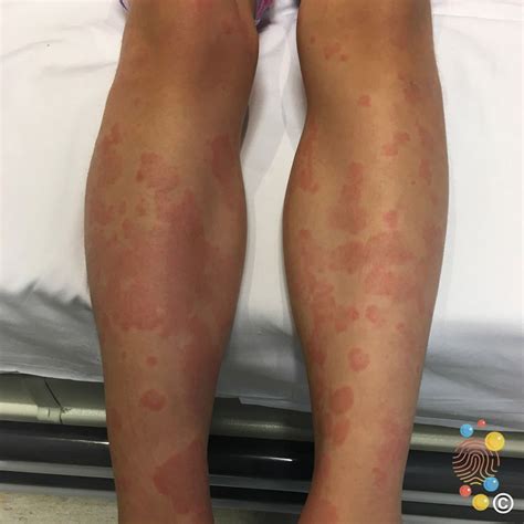 Idiopathic Urticaria