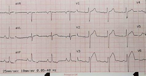 Dr Smiths Ecg Blog Anterior Stemi Or Benign Early Repolarization