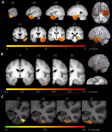 Voxel Based Lesion Symptom Mapping Vblsm Showing Regions Associated