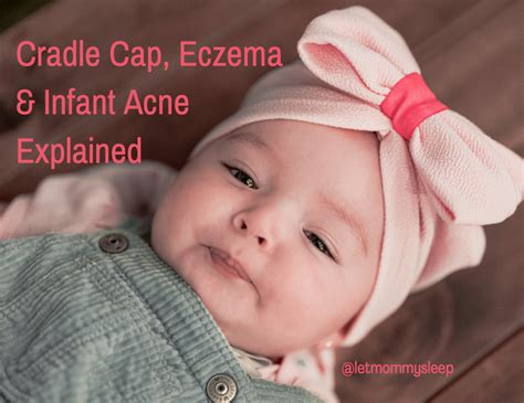 Cradle Cap Eczema And Infant Acne Explained