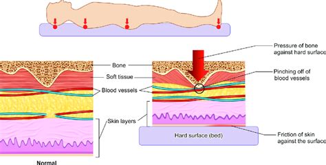 Pathophysiology Of Pressure Sore Download Scientific Diagram