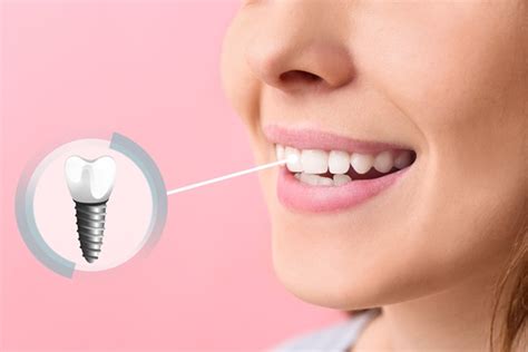 What To Ask Your Dentist About Dental Implants Island Paradise Dental