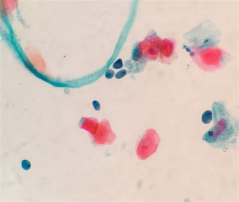 Pathology Outlines Amebic