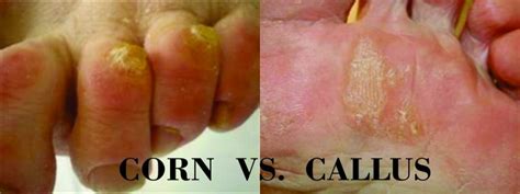 Corn vs. Callus – Everything You Need To Know - Fix Ugly Nails