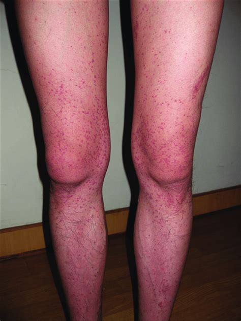 Typical Palpable Purpura On The Legs Of A Patient With HenochSchonlein