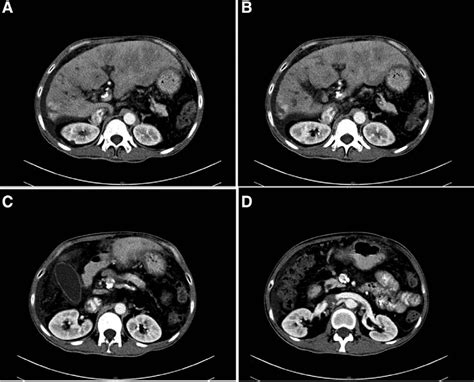 The contrast-enhanced CT of the abdomen of patient. (A and B) Enhanced... | Download Scientific ...