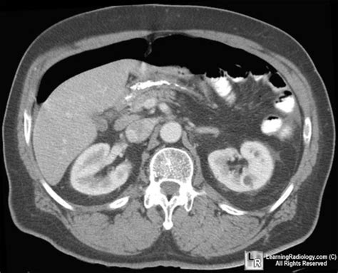 Learningradiology Free Air Pneumoperitoneum Crescent Sign Rigler