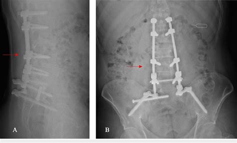 X Rays At One Year Follow Up A Lateral B Anteroposterior Ap The Download Scientific