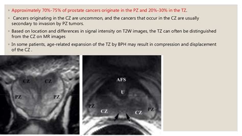 PROSTATE MRI IMAGING - PIRADS V2 2015