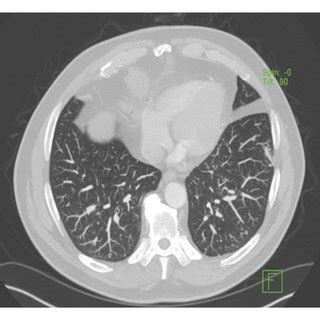 Chest CT showing numerous small lung nodules. | Download Scientific Diagram