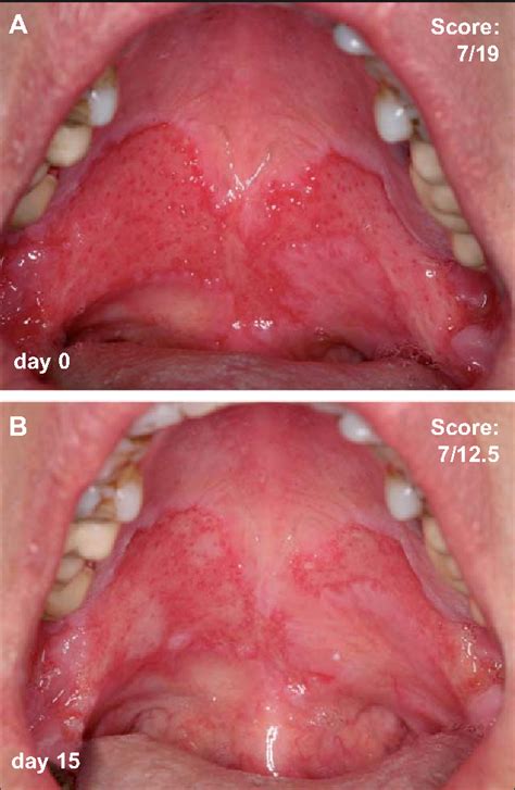 Pdf Introducing A Novel Autoimmune Bullous Skin Disorder Intensity