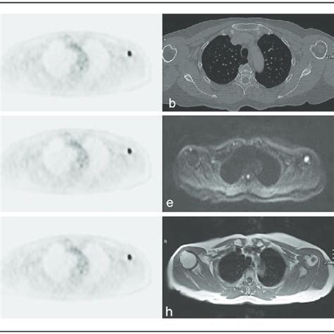 Focal Bone Marrow Involvement A 70 Year Old Female Patient With