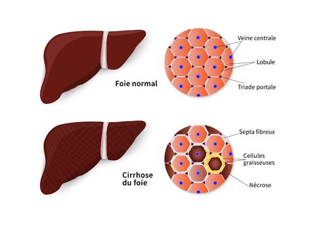 Cirrhose Du Foie Causes Symptômes Et Traitements Information Hospitalière Lexique Et