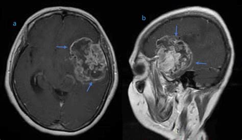 High Grade Glioma Aaron Cohen Gadol Md