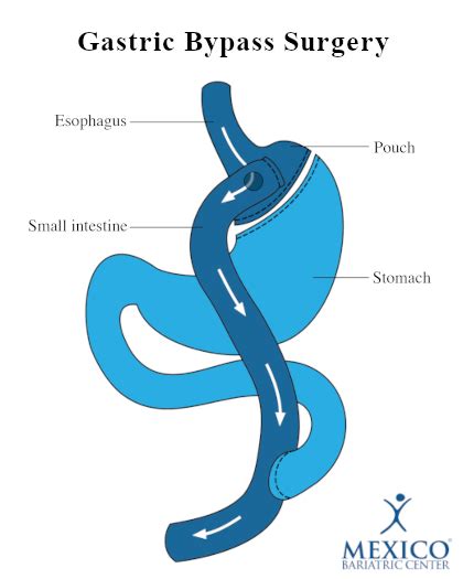 Roux-en-Y Gastric Bypass Surgery Complications, Risks