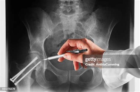 Hip Fracture X Ray Photos and Premium High Res Pictures - Getty Images