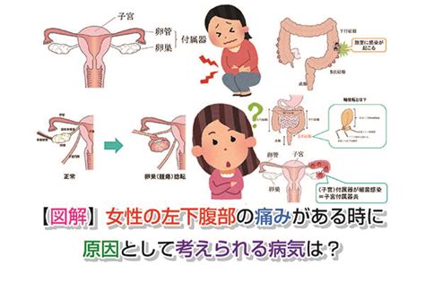 【図解】女性の左下腹部の痛みがある時に原因として考えられる病気は？