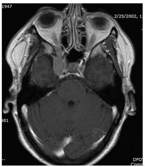 Primary Central Nervous System Tumors Neupsy Key