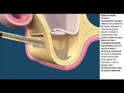 Atrofia Ossea E Enxertia Atrofia Seio Maxilar E Enxertia Levantamento