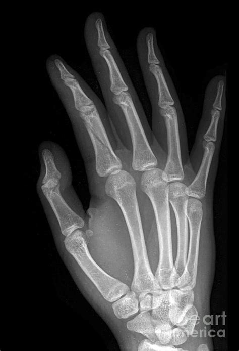 Second Phalanx Fracture Of The Hand Photograph By Rajaaisyascience