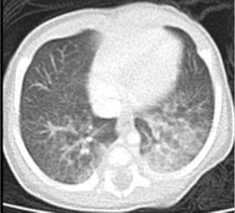 Figure 1 From Unusual Cause Of Respiratory Distress In A Term Neonate Semantic Scholar