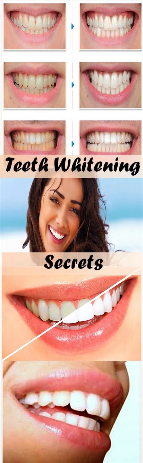 At-Home Teeth Whitening vs. Dentist-Supervised Teeth Whitening ...